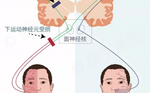 中枢性面瘫还是周围性面瘫？