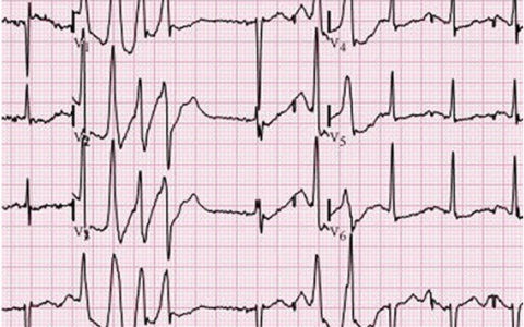 A 53-year-old man with is admitted to the ICU after a Whipple procedure
