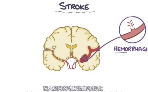 【Osmosis医学】蛛网膜下腔出血 – Subarachnoid Hemorrhage