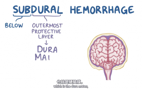 【Osmosis】Subdural Hematoma 硬膜下血肿