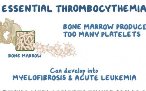 【Osmosis】Essential Thrombocythemia 原发性血小板增多症