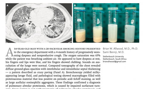 肺泡蛋白沉积症的碎路石征