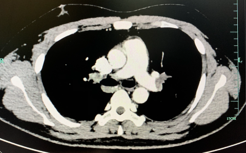心悸胸闷伴腹泻3天，发热1天_20200527