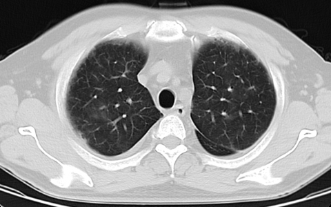 咽痛伴发热20天_20200530