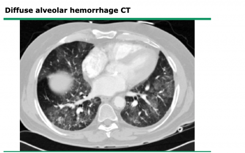 弥漫性肺泡出血的常见病因