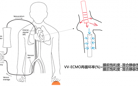 推算VV-ECMO再循环率