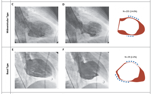 应激性心肌病（心碎综合征）