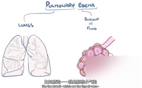 【Osmosis】肺水肿 Pulmonary Edema（中英字幕）