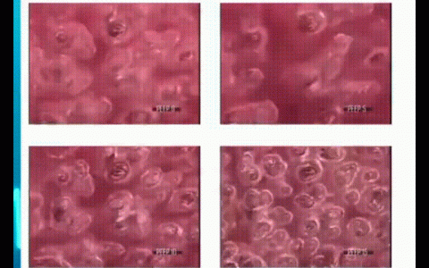 ARDS患者如何设置PEEP水平