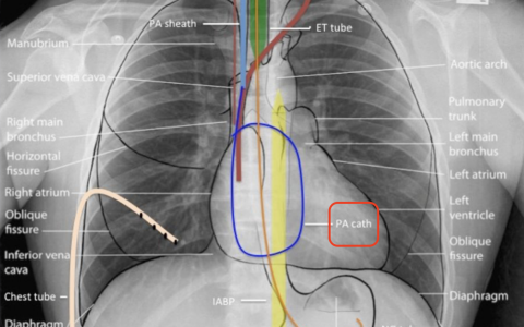 Swan-Ganz漂浮导管