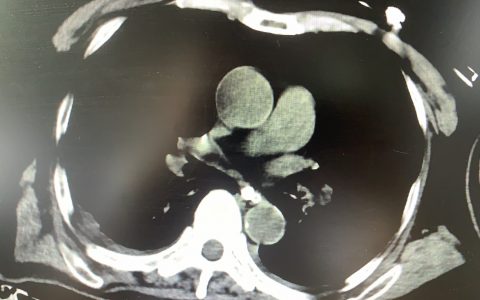 ICU基本技能培训_气管插管