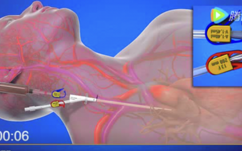 CRRT置管术（颈内静脉）