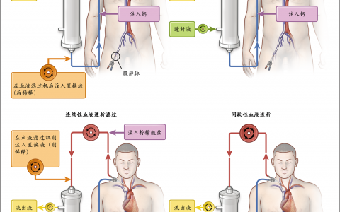 NEJM：急性肾损伤的体外肾脏替代疗法