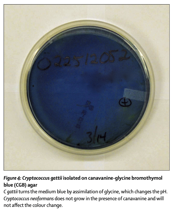 Lancet：Management of Cryptococcus gattii meningoencephalitis