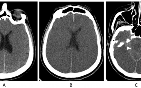 Journal of Intensive Care：脑死亡：临床综述