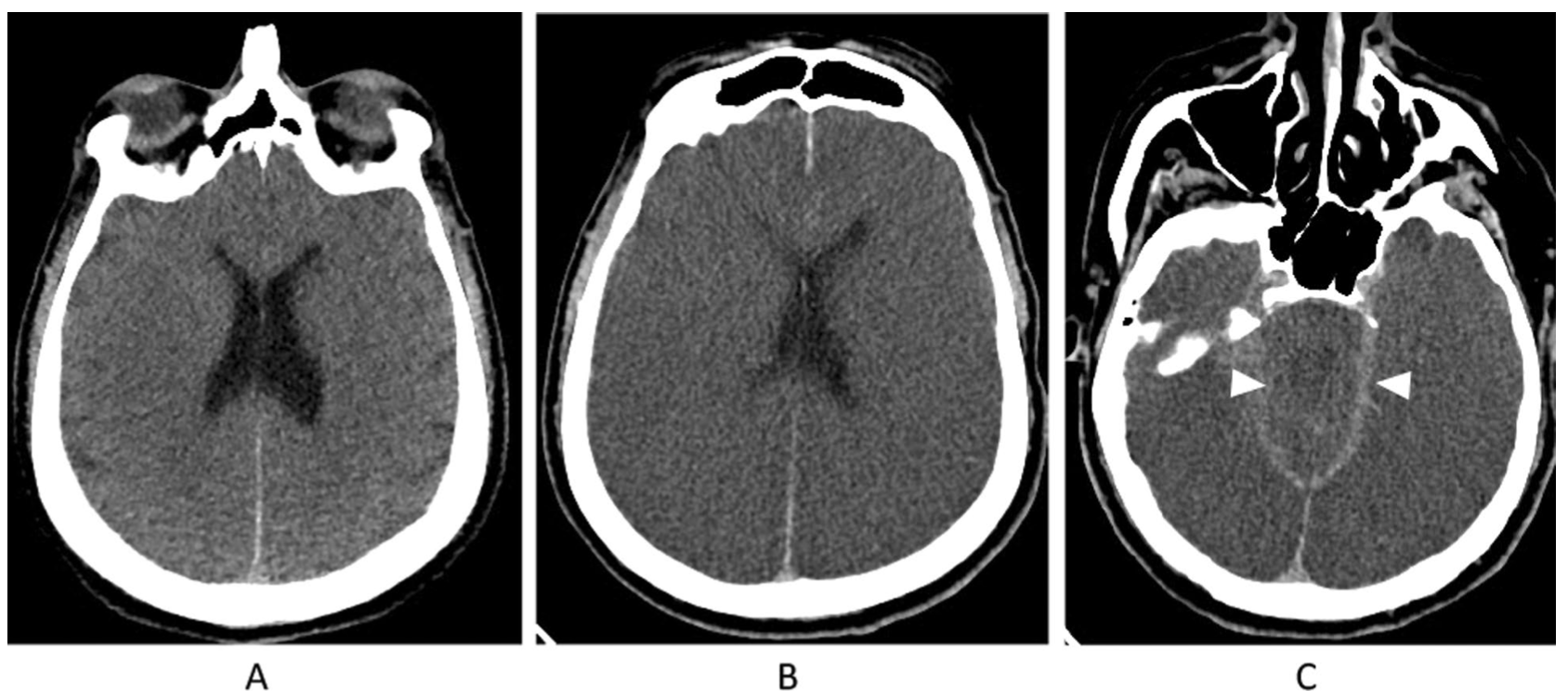 Journal of Intensive Care：脑死亡：临床综述