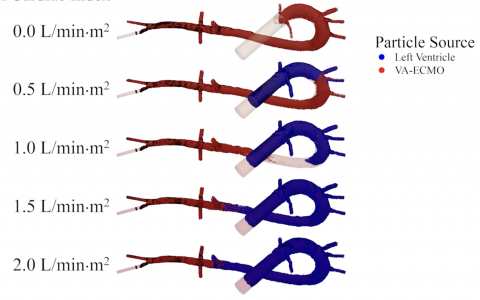 va-ecmo的南北综合征