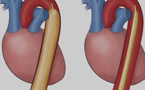 主动脉内球囊反搏操作规范(中山医院版)