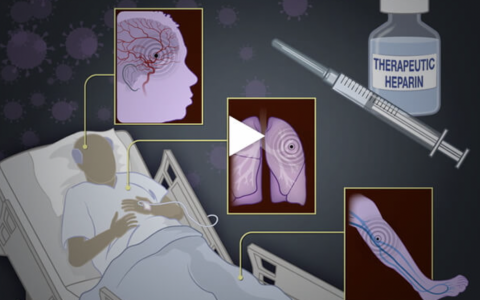 NEJM: COVID-19住院患者的治疗剂量肝素抗凝