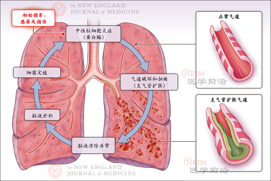NEJM: 支气管扩张——临床综述