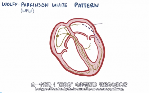 【Osmosis】预激综合征
