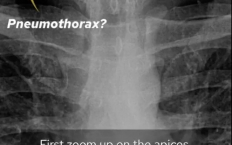 临床基础：90秒学会看胸片