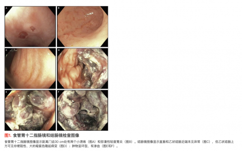 病例3-2023——一名患腹痛和血性腹泻的16岁少女