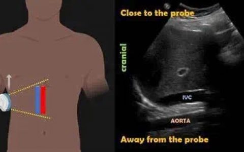 经肝下腔静脉超声