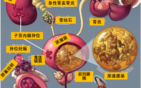 泌尿生殖系统导致的腹痛