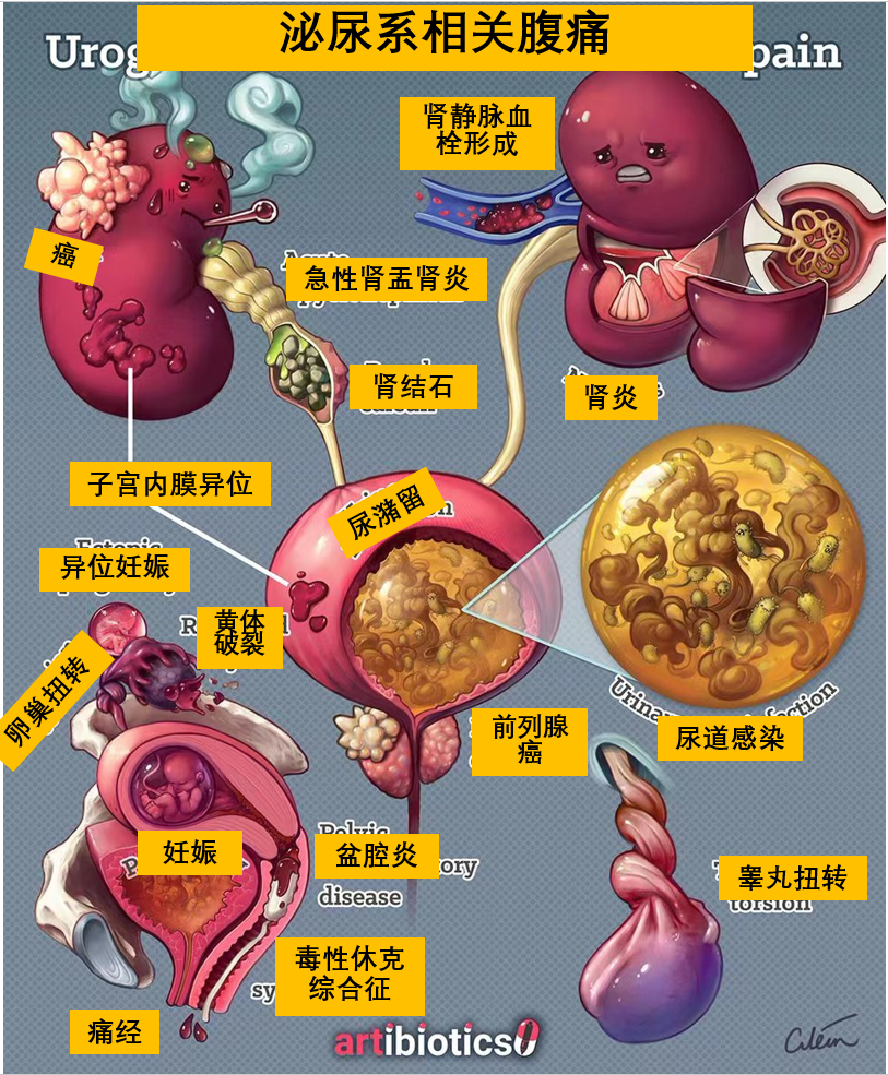 泌尿生殖系统导致的腹痛