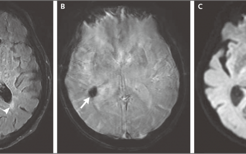 病例2-2023——一名患头晕和精神状态改变的76岁男性