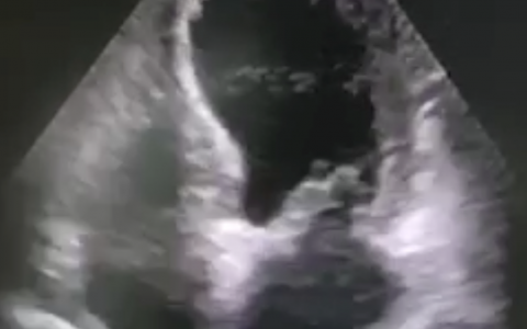 应激性心肌病1例