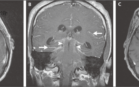 NEJM: 慢性脑膜炎