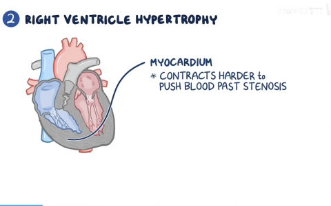 【Osmosis 】法洛四联症
