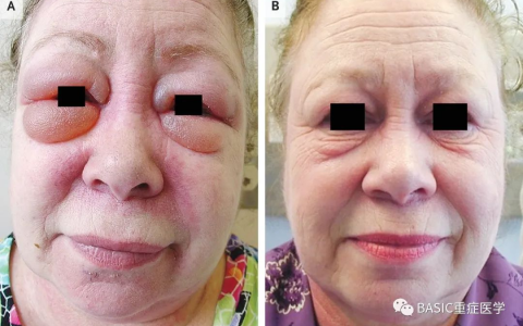 [NEJM临床医学影像]：皮肌炎的眶周水肿