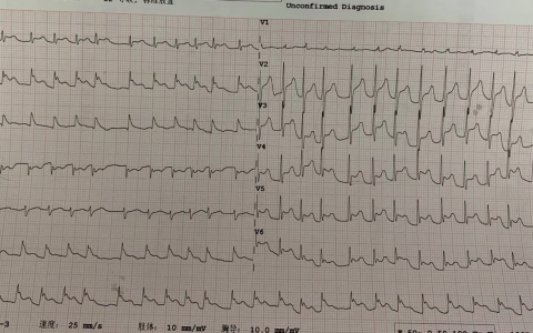 心肺复苏术后1小时_20230603