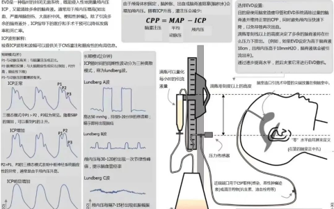 脑室外引流装置的应用图解