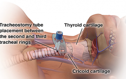 经皮气管切开术