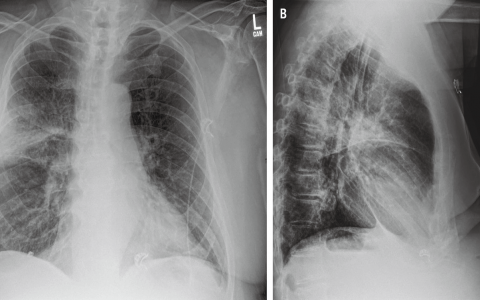 NEJM: 社区获得性肺炎