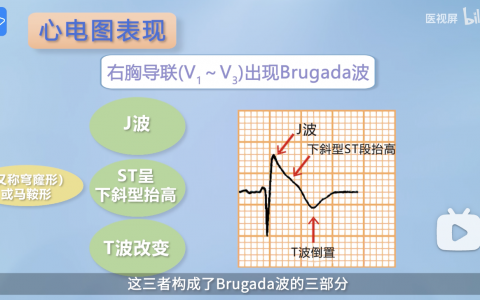Brugada综合征