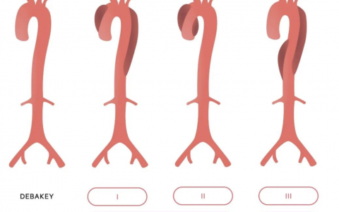 主动脉夹层经典分型