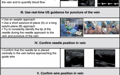 颈内静脉穿刺置管 “七步法”