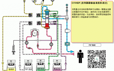CRRT常见模式示意图