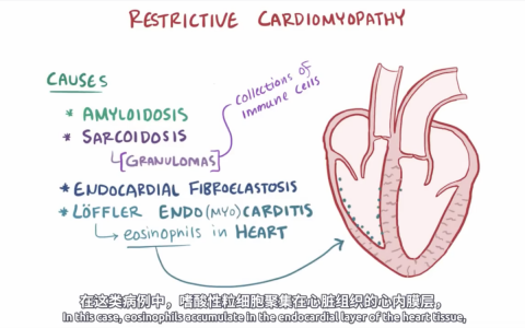 【Osmosis】限制性心肌病