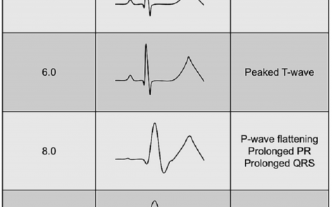 高钾血症引起的心电图变化