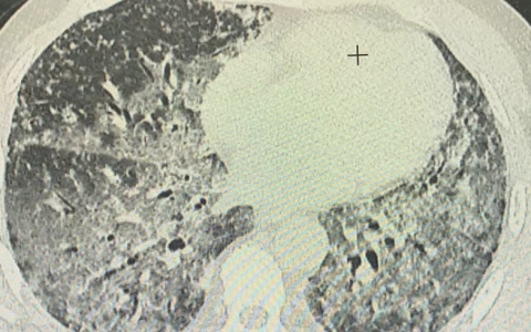 经典影像-弥漫性肺泡出血_20240415