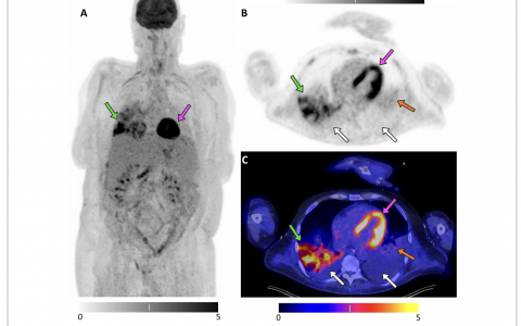 ICM:18F-氟脱氧葡萄糖正电子发射断层扫描/计算机断层扫描区分机械通气患者中的肺炎和肺不张