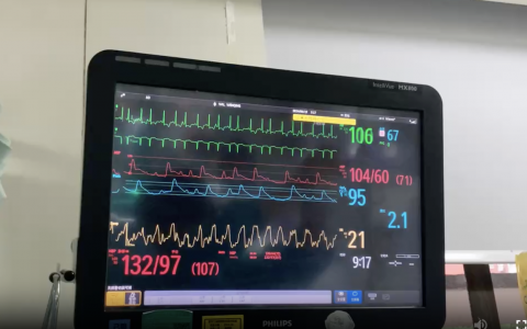 通过监护仪动脉波形判断容量缺