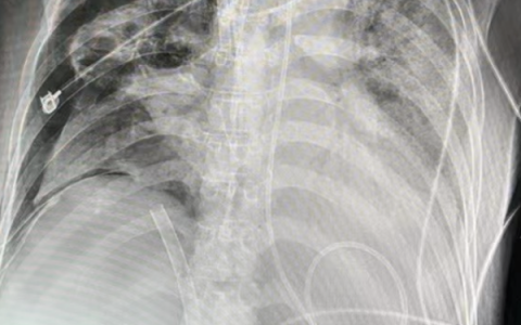 VA-ECMO静脉管路的头端误入肝静脉