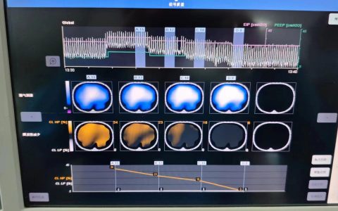 俯卧位对肺实变的影响